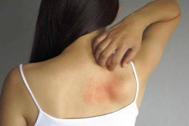 padecen-dermatitis-atopica-15-de-los-adolescentes-mexicanos-1.jpg