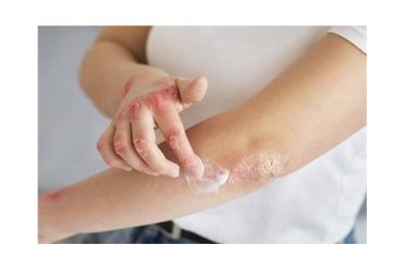 la-psoriasis-afecta-a-2.5-millones-de-mexicanos-actualmente1.jpg