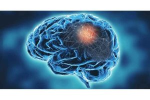 enfermedades-cronico-neurodegenerativas-afectan-mas-a-mujeres-1.jpg