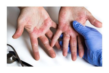 dermatitis-atopica-e-higiene-efectiva-de-manos1.jpg