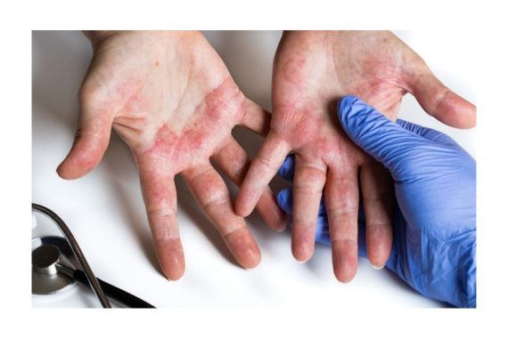 dermatitis-atopica-e-higiene-efectiva-de-manos1.jpg